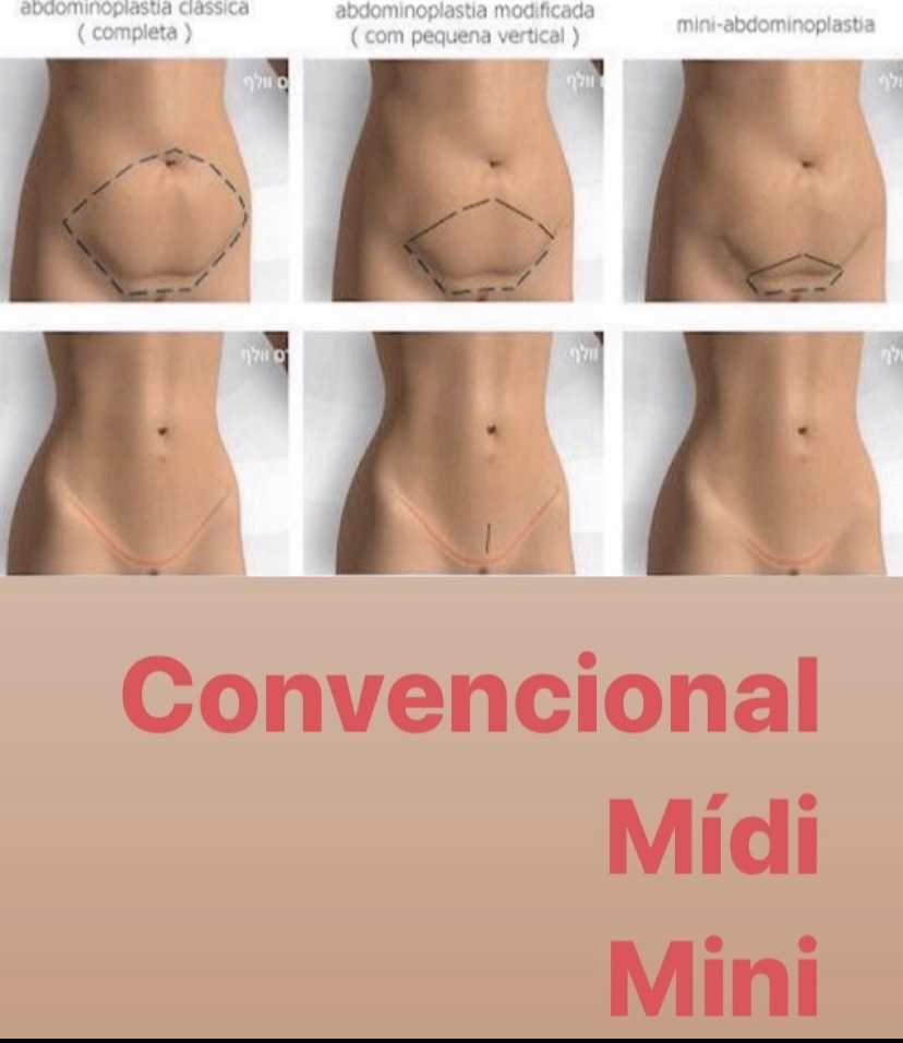 Abdominoplastias  Dra. Rebeca Janebro